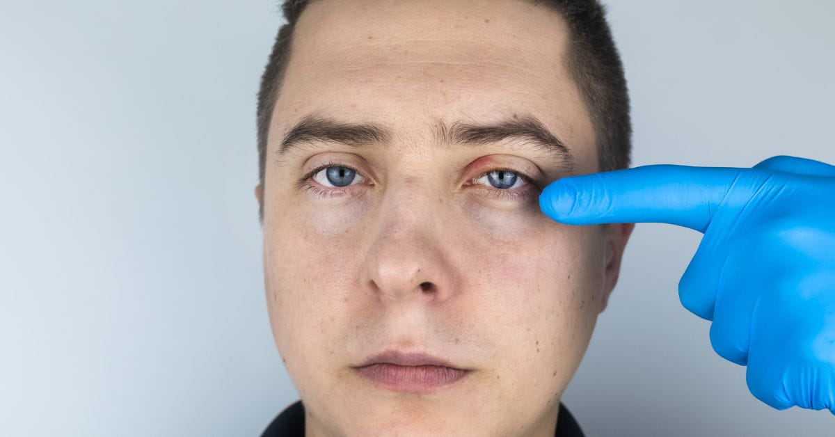 Blepharitis